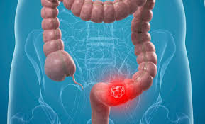 Kolon Kanseri - Tıbbi Görsel